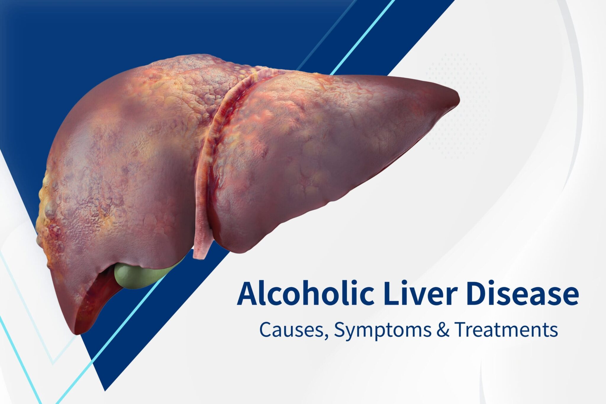 alcoholic-liver-disease-causes-symptoms-and-treatments